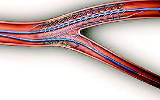 【午夜精品久久久】日本午夜福利视频APP设备处理血管支架